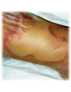 Hydrocoll - pansament cu hidrocoloid 10cm x 10 cm , 10... 2