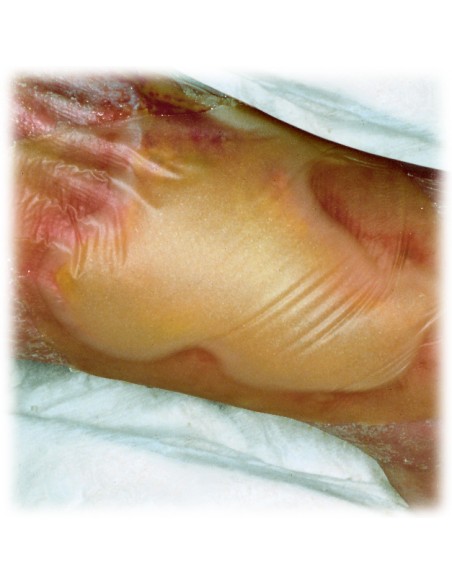 Hydrocoll- pansament cu hidrocoloid 5cm x 5cm, 10 bucati, PAUL HARTMANN AG