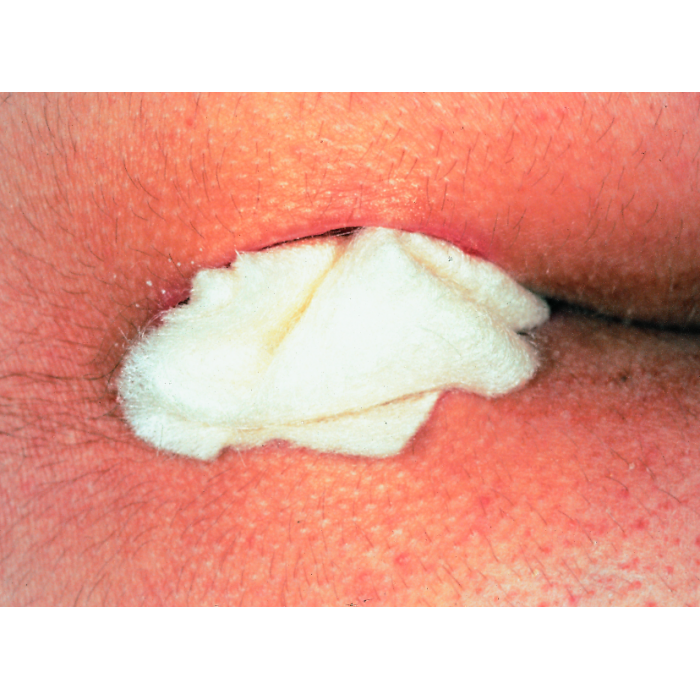 Sorbalgon 10 × 20 cm – pansament din alginat de...