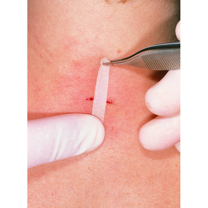 Omnistrip 6mm x 76 mm - plasture pentru...